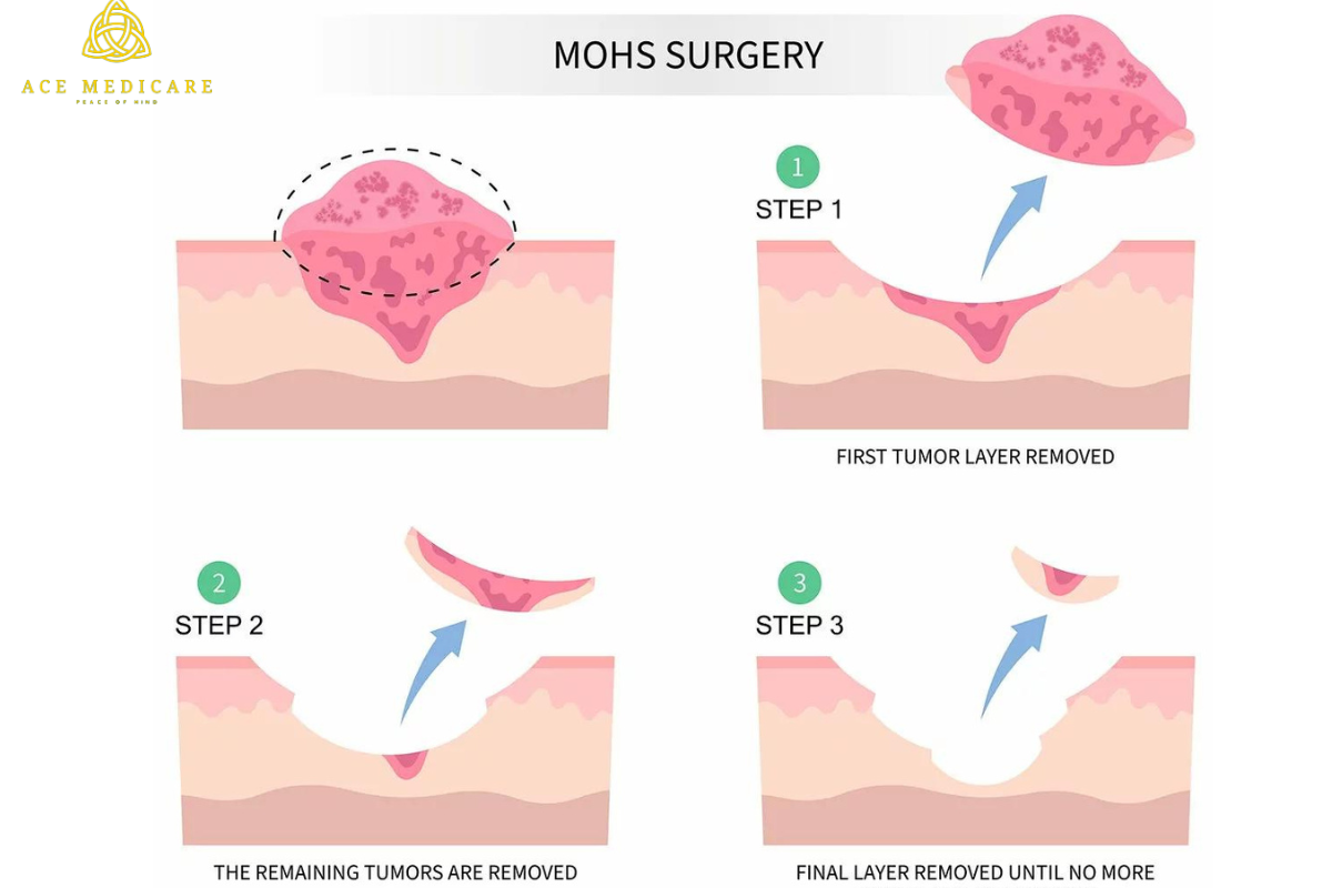 The Ultimate Guide to Mohs Surgery: What You Need to Know